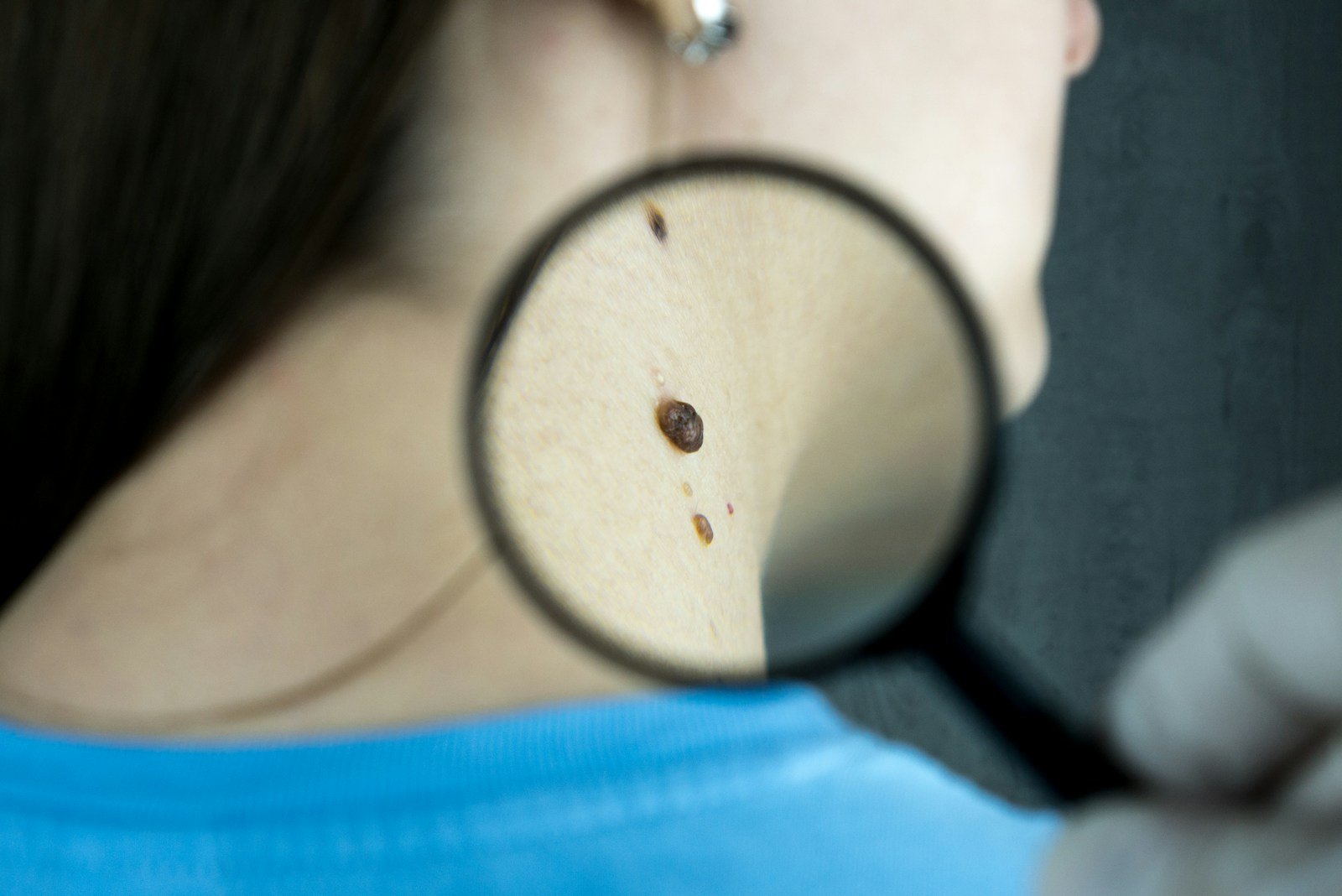 Un dermatologue examine un grain de beauté au dermatoscope
